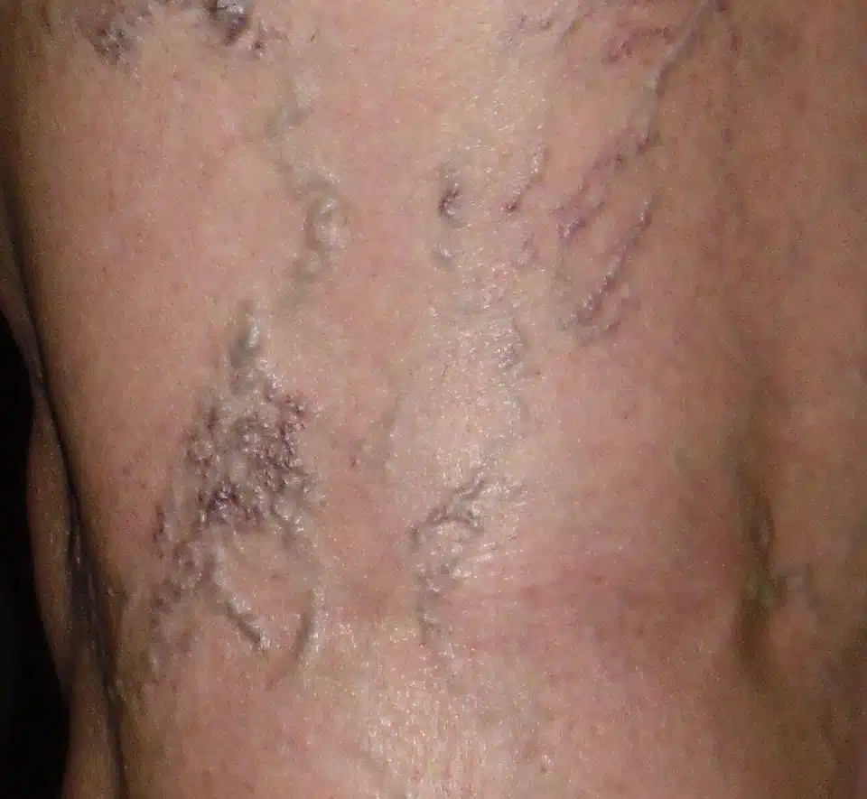 varicose veins treatment
