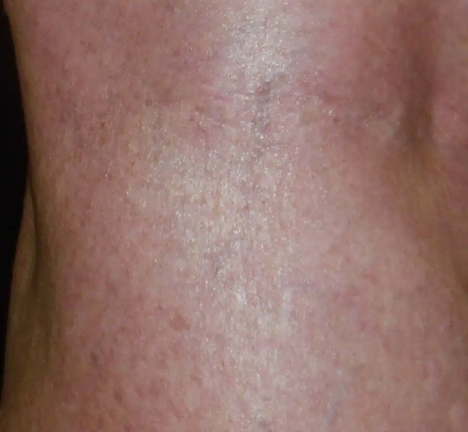 eliminar varices piernas