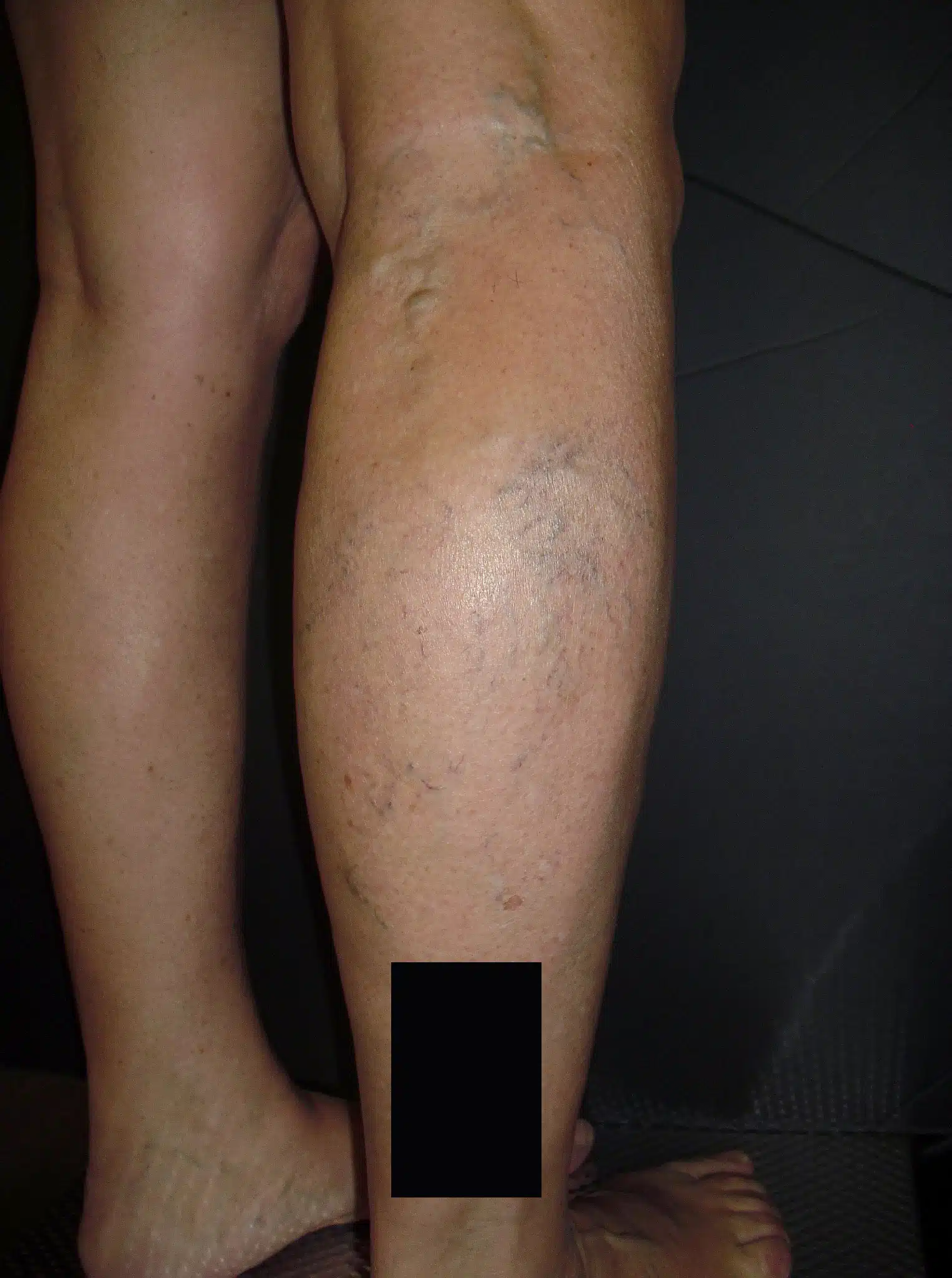 eliminación varices piernas
