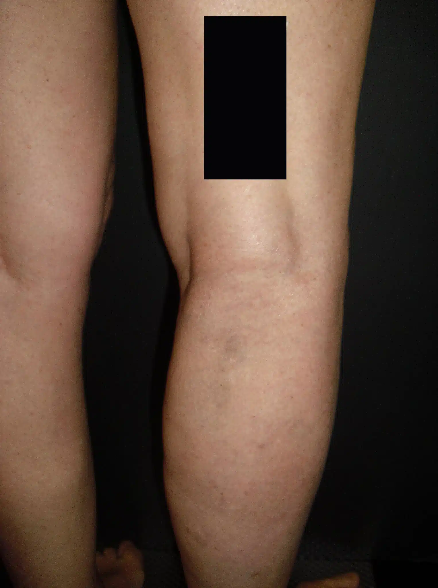 tratamiento eliminar varices