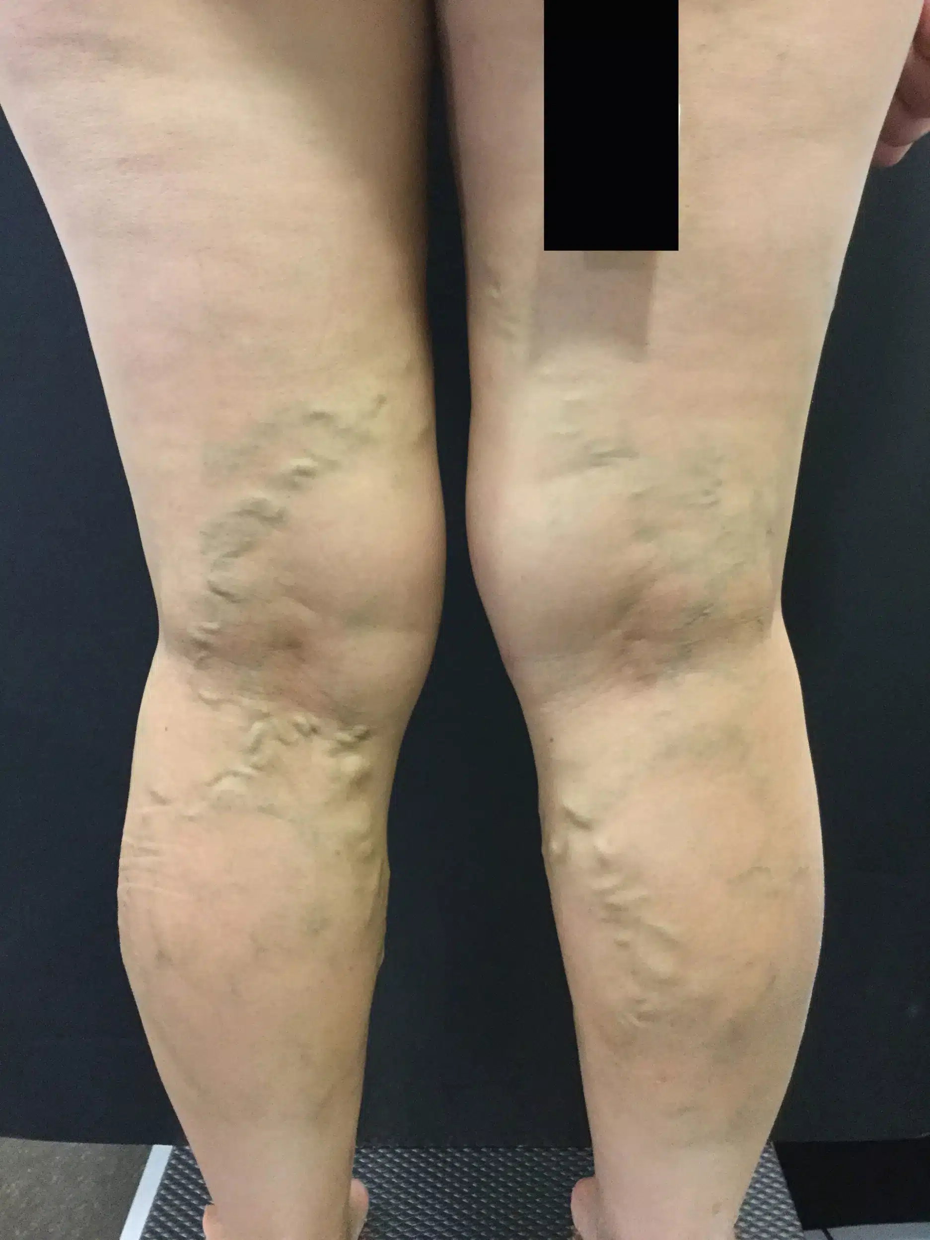 VARIXIO tratamiento varices