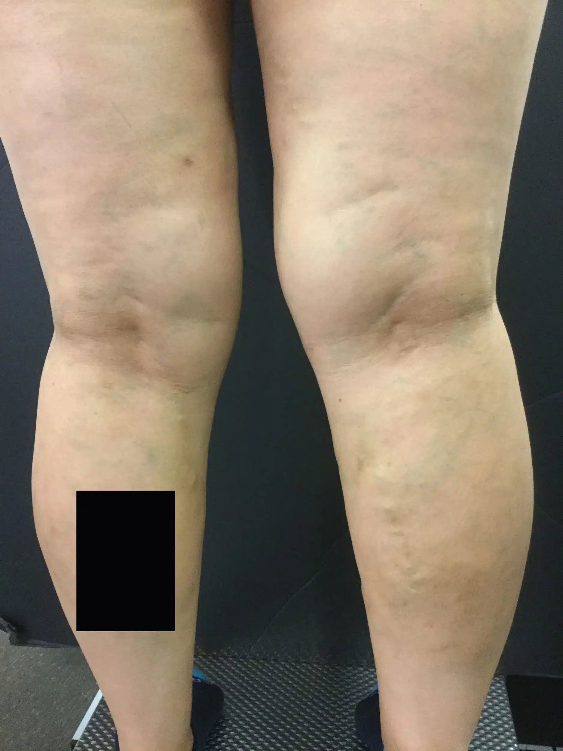 mejor tratamiento varices