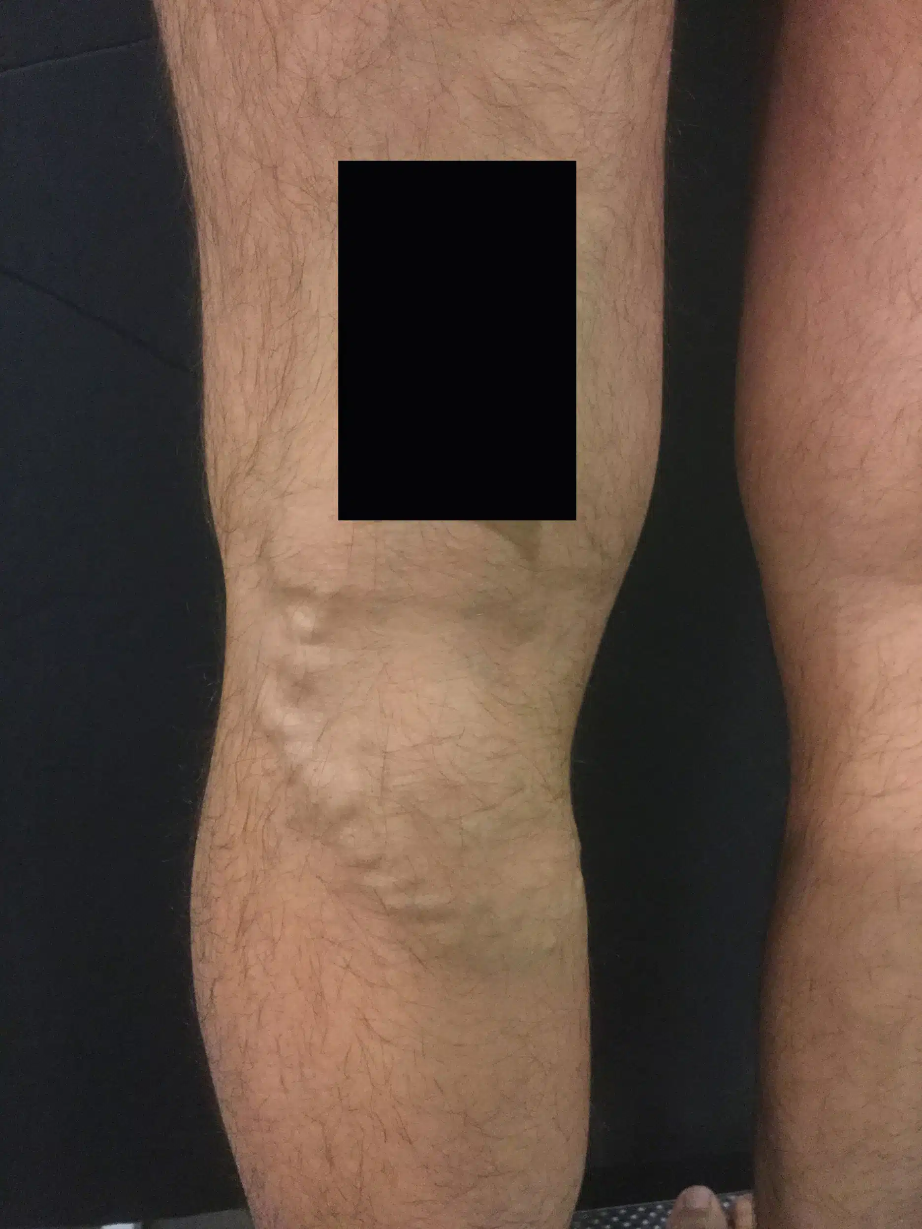 eliminación varices hombre