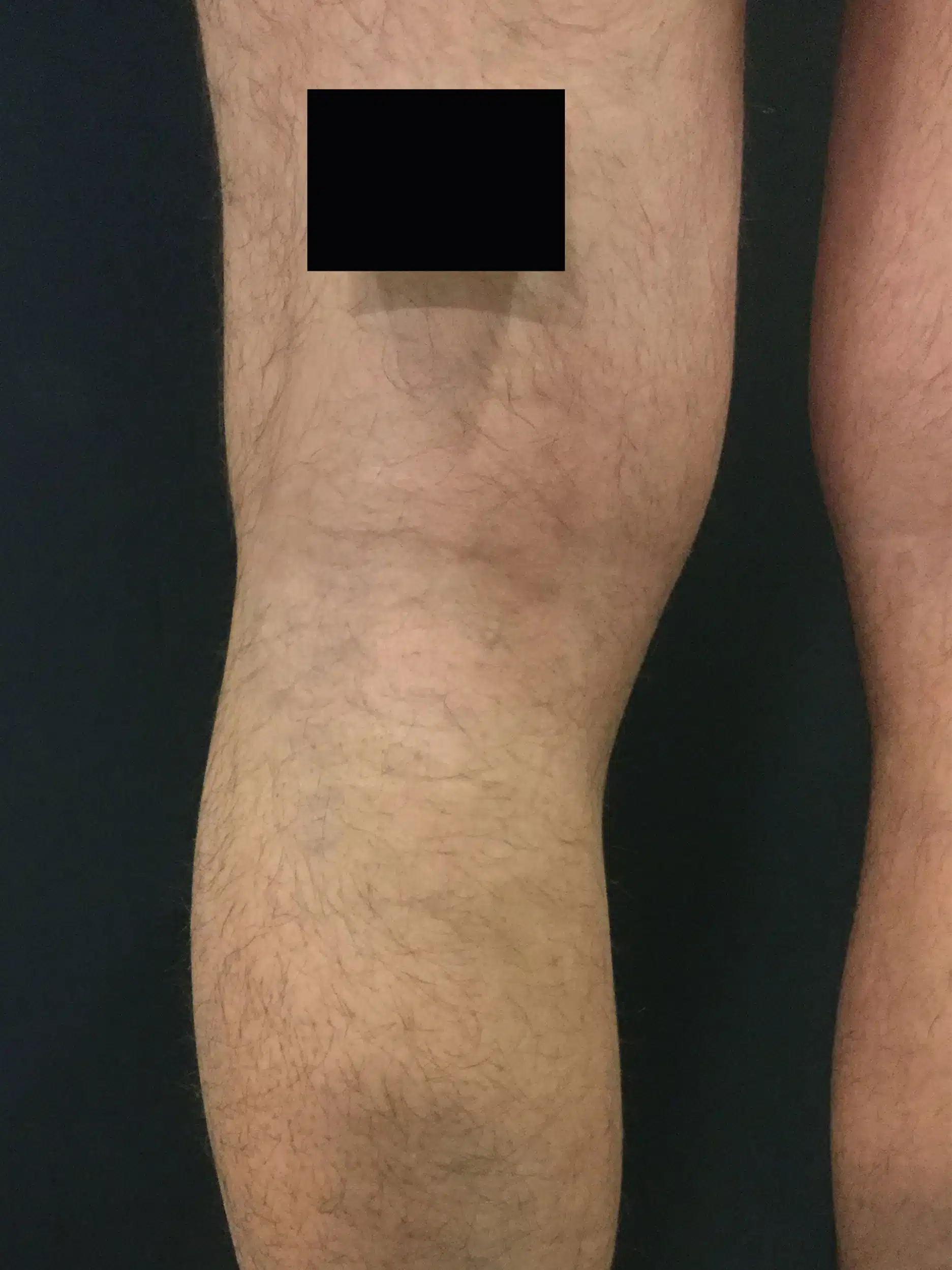 mejor tratamiento varices