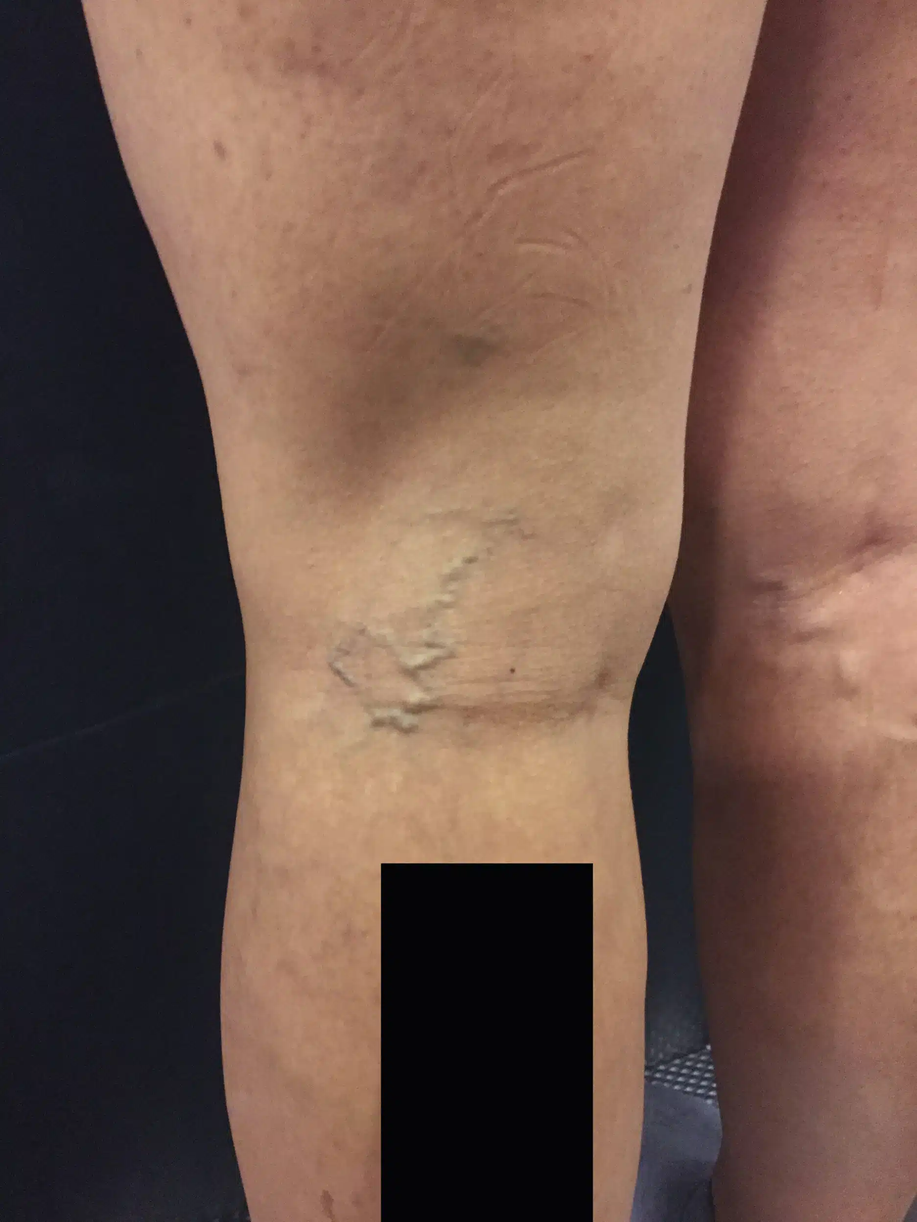 tratamiento varices