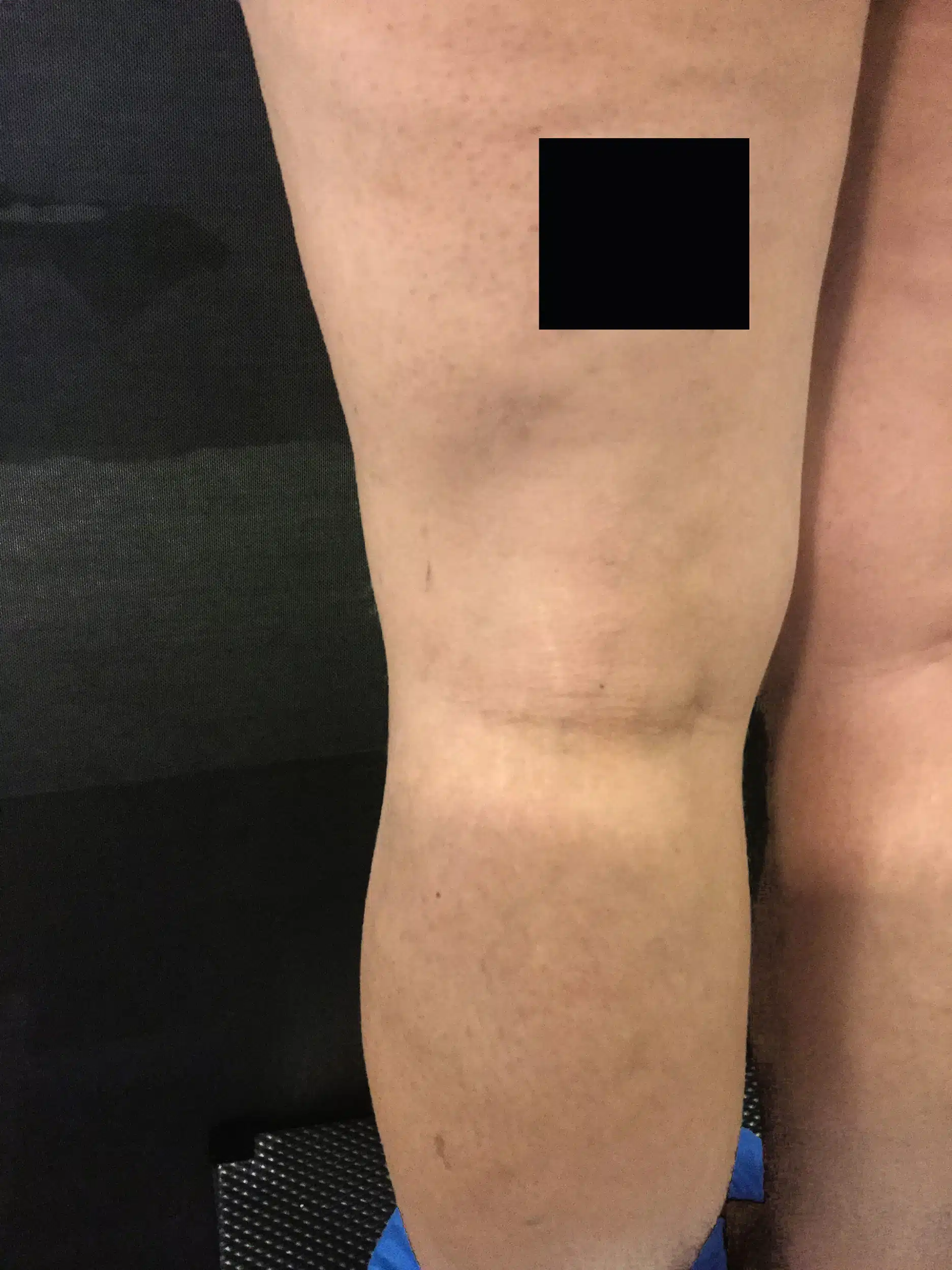 eliminación varices piernas